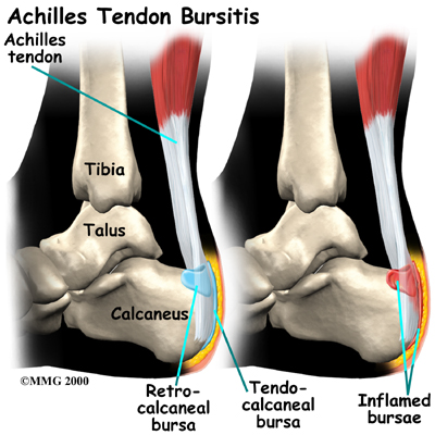 Achilles tendon lengthening surgery in adults Undertale anal vore