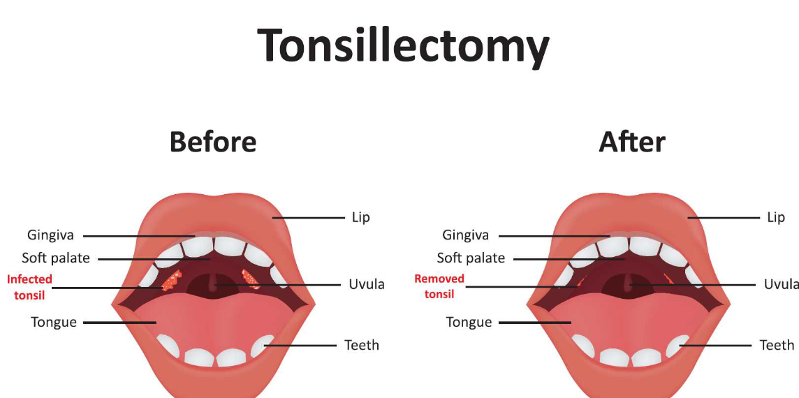 Adult tonsillectomy reddit Best porn video search engine
