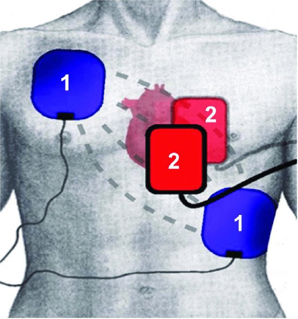 Aed anteroposterior placement for adults Morphle porn