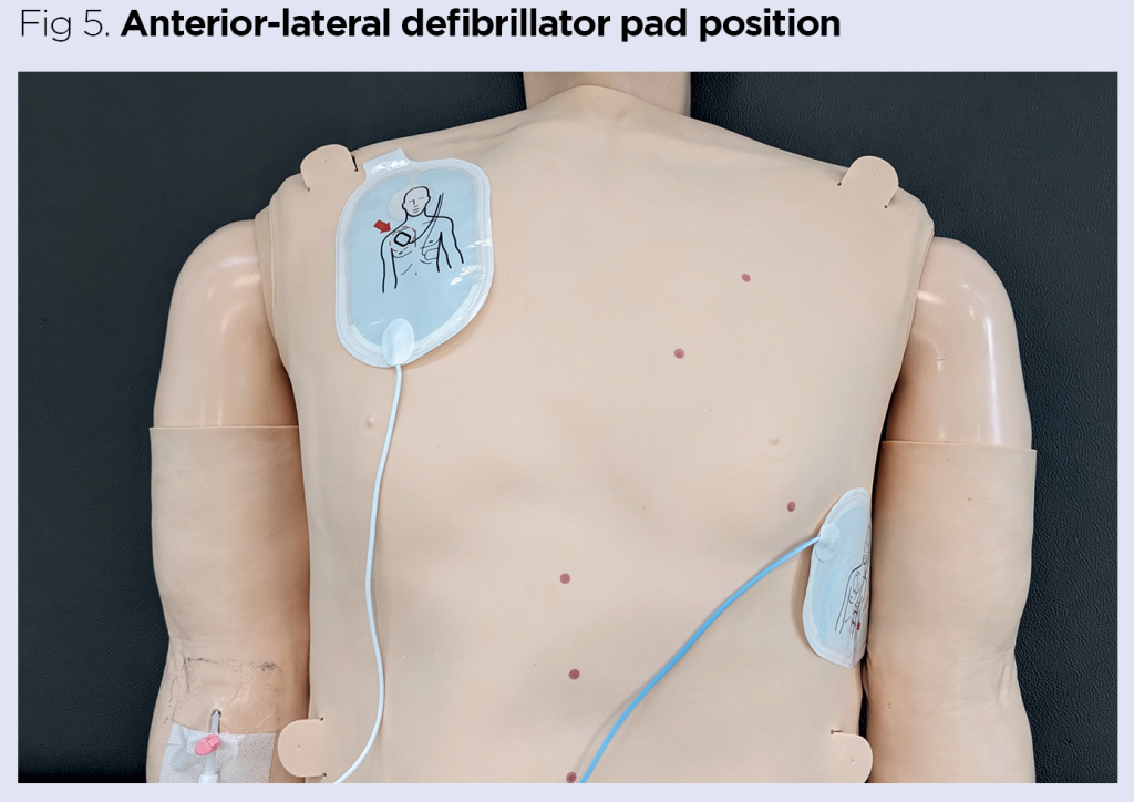 Aed anteroposterior placement for adults Hd porn with story