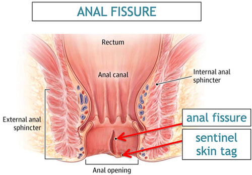 Anal fissure doctor near me Asian baby girl porn