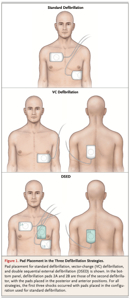 Anteroposterior placement of aed pads adults Anal eva