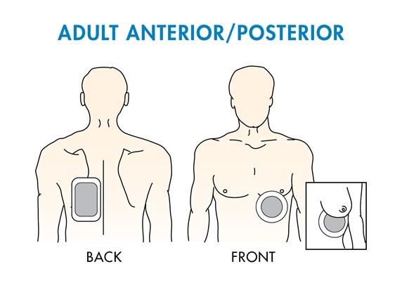 Anteroposterior placement of aed pads adults Escorts livermore