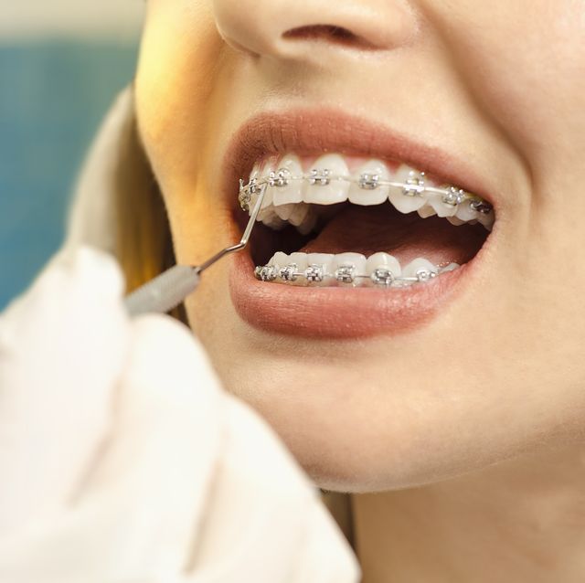 Best teeth braces for adults Livia fetish