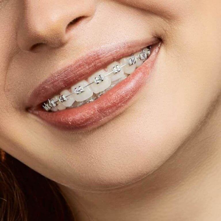 Best teeth braces for adults Littlenatie porn