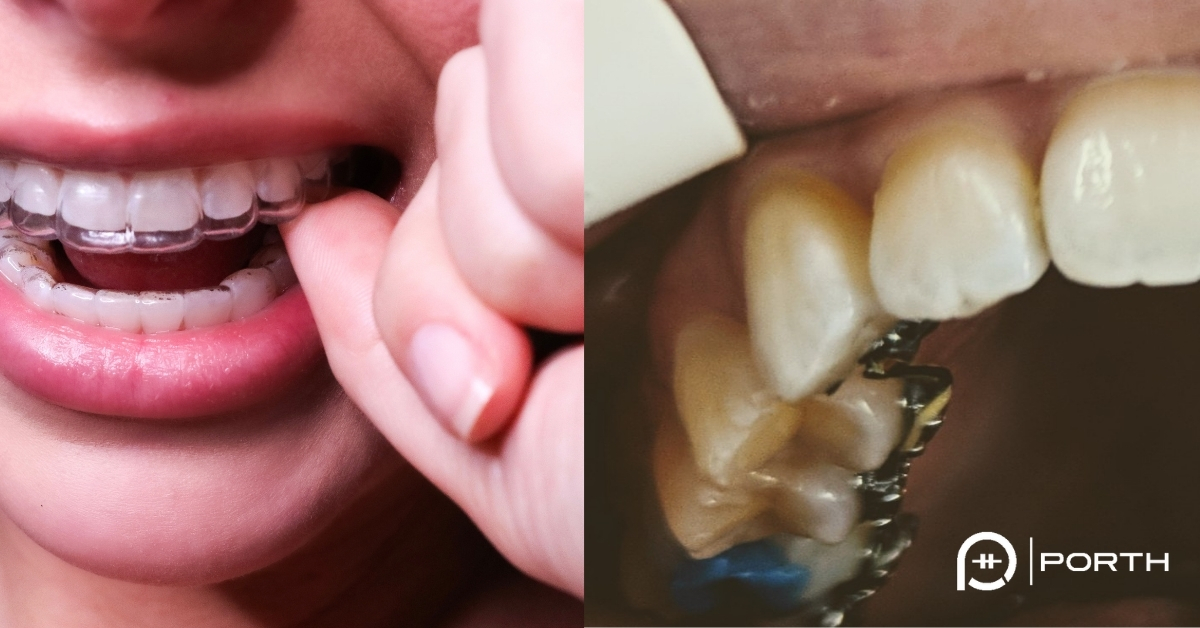 Best teeth braces for adults Lesbian three way kiss