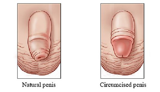 Circumcision for adults near me Arquez pornstar
