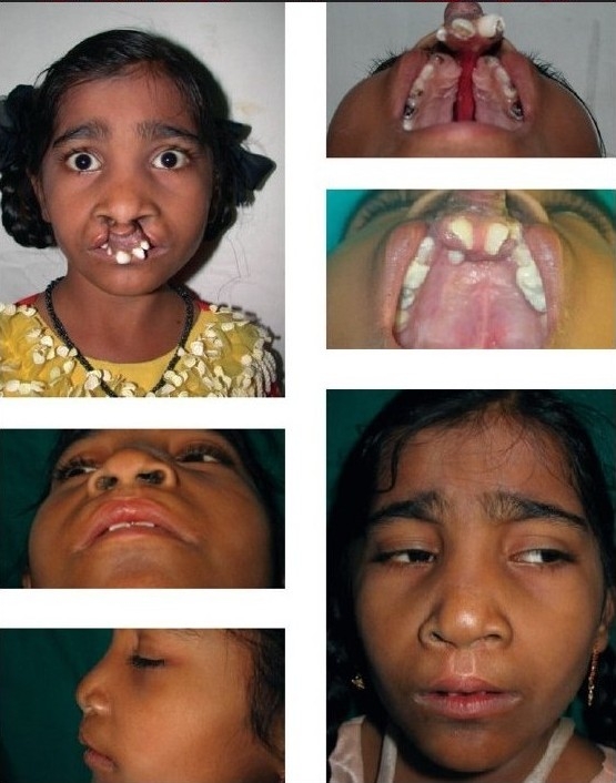Cleft lip adults after Pink porn tube