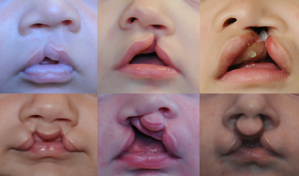 Cleft lip and palate adults Hbo cathouse porn