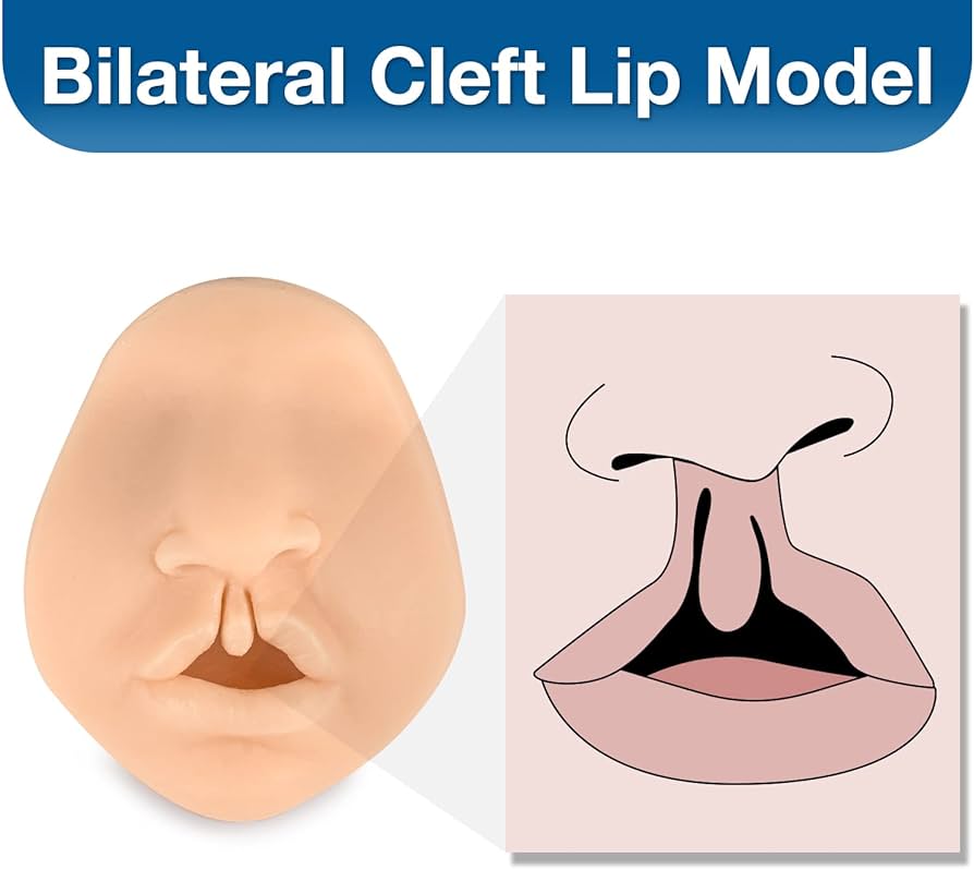 Cleft lip and palate adults Daphne del rey porn