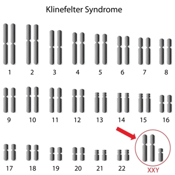 Dating someone with klinefelter syndrome Squishy face porn