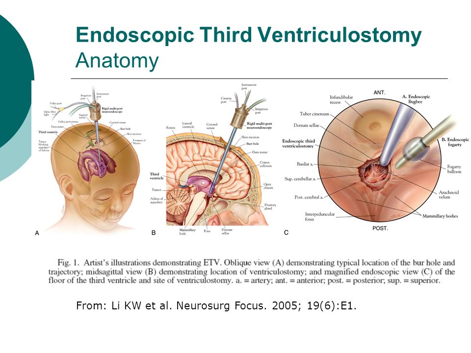 Endoscopic third ventriculostomy in adults Missmaples porn