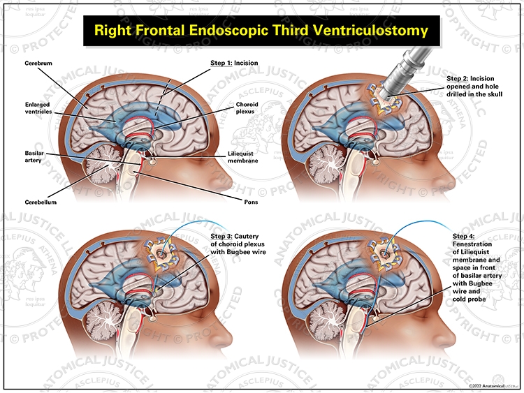 Endoscopic third ventriculostomy in adults Xxxvideos porn