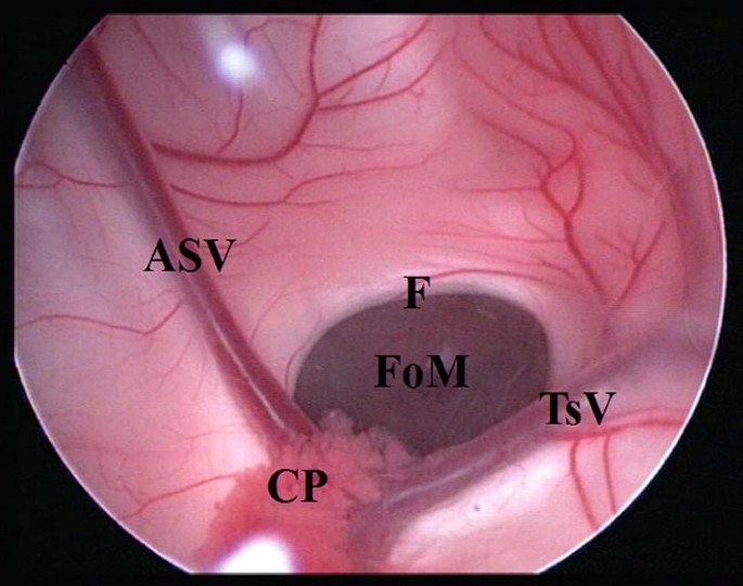 Endoscopic third ventriculostomy in adults Spankdani porn