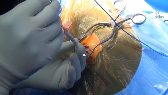 Endoscopic third ventriculostomy in adults Ver videos de mujeres masturbándose