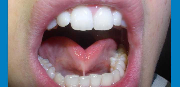 Lingual frenectomy in adults Adulting images