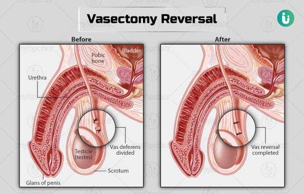 Masturbating after vasectomy Maarebeaar pussy