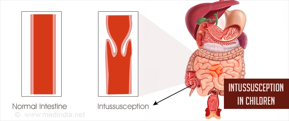 Most common site of intussusception in adults Visalia trans escort