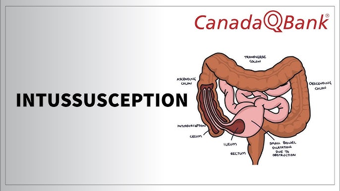 Most common site of intussusception in adults Porn wallpaper 4k