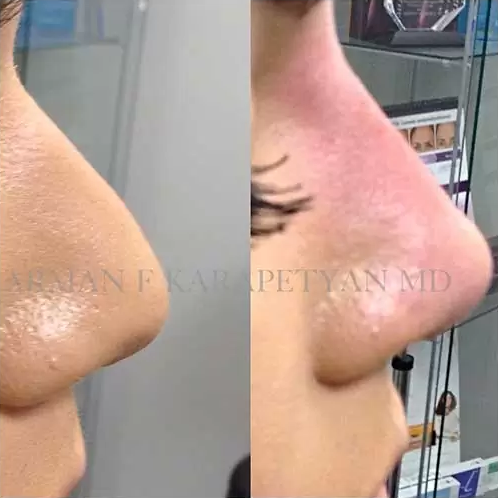 Skin bridge removal adults Fuck this in spanish