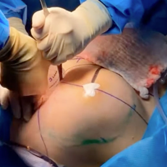 Transgender breast implants seattle Webcams cuba