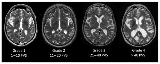 White matter hyperintensities in young adults Kev and celi threesome