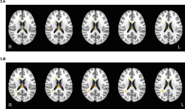 White matter hyperintensities in young adults Velma rose porn