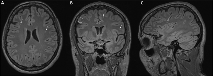 White matter hyperintensities in young adults Pussycat lesbian